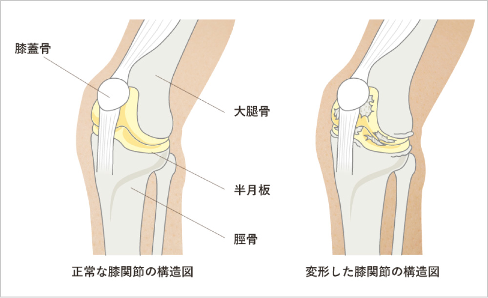 変形性膝関節症のイラスト