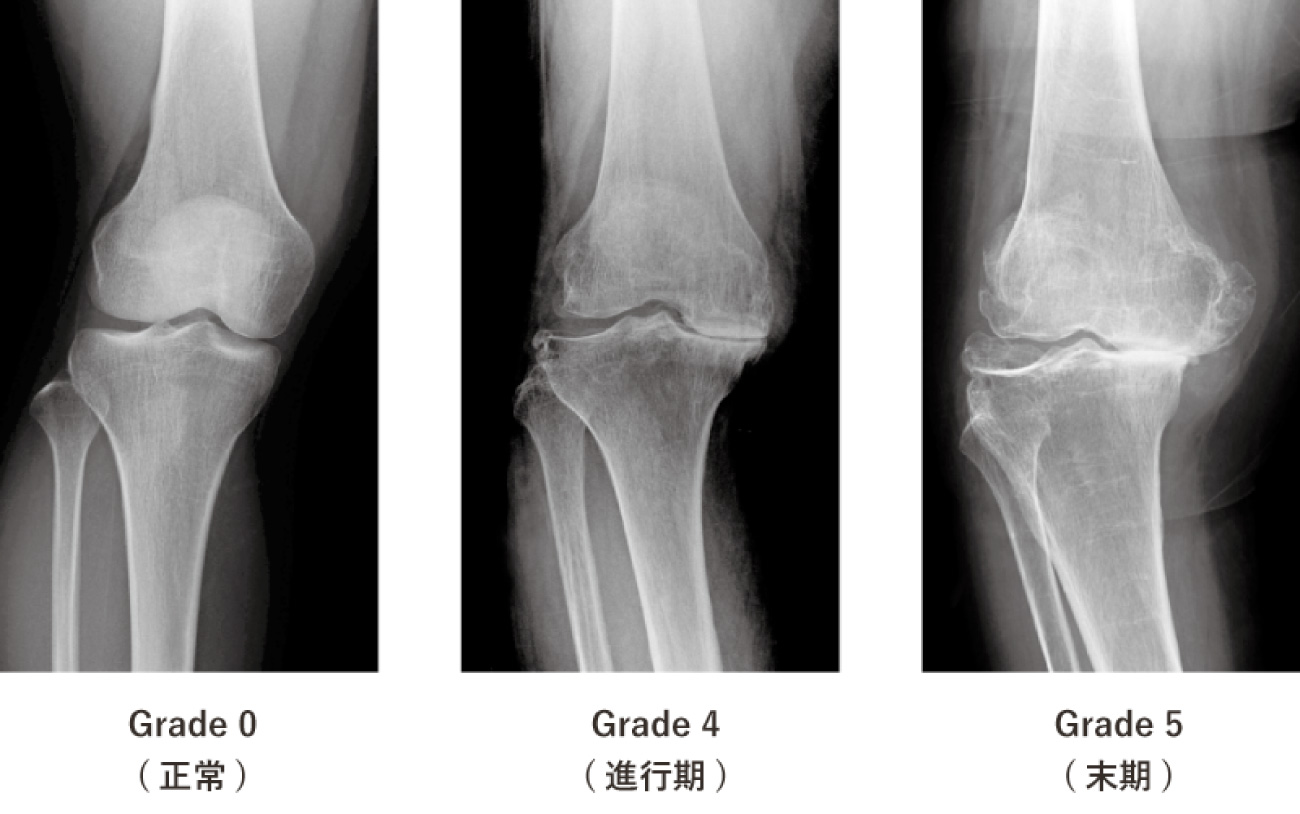変形性膝関節症のレントゲン画像