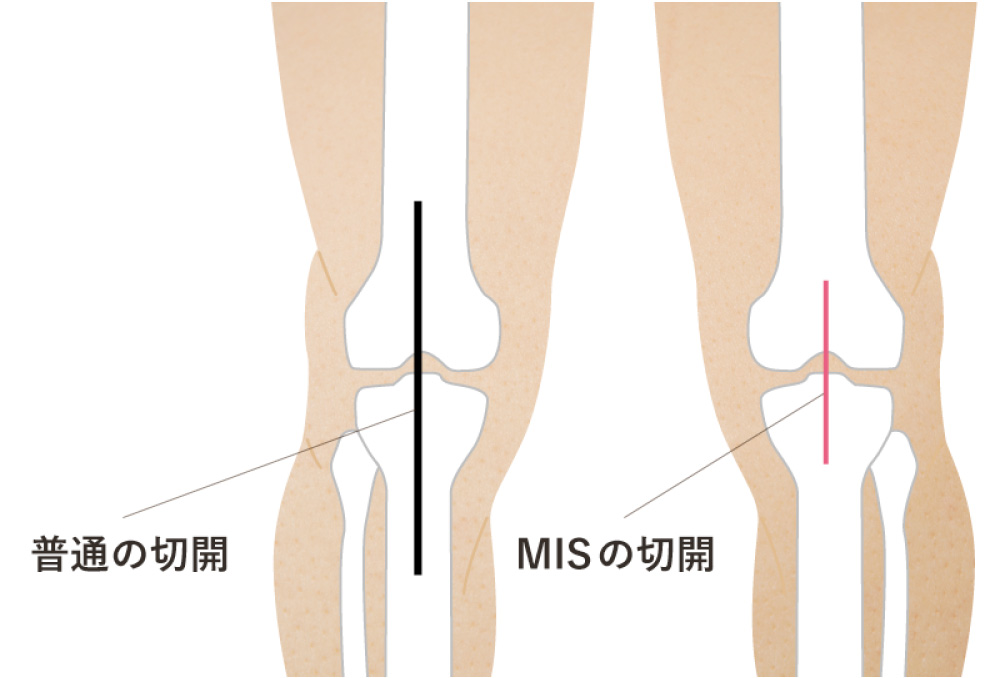 MIS(低侵襲手術)