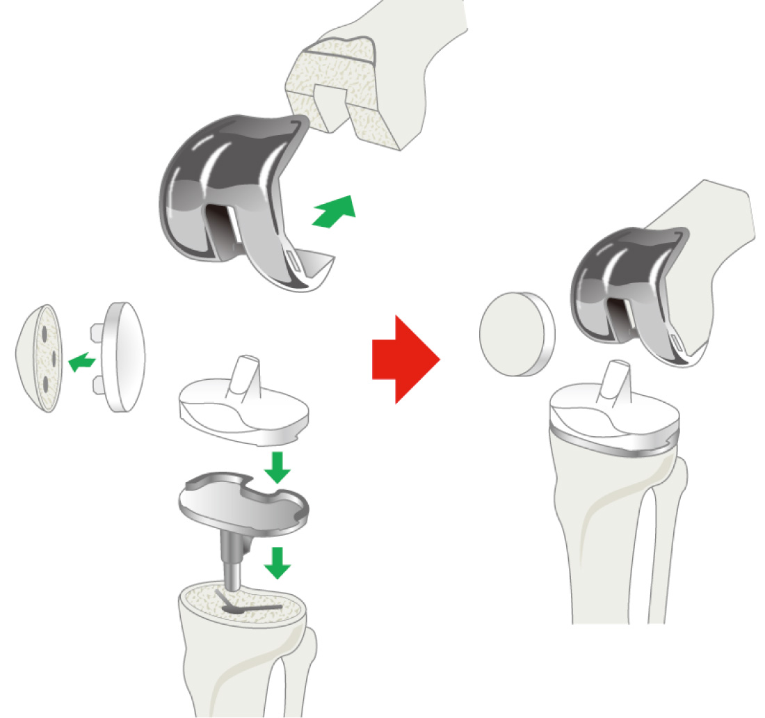 人工膝関節置換術(TKA)