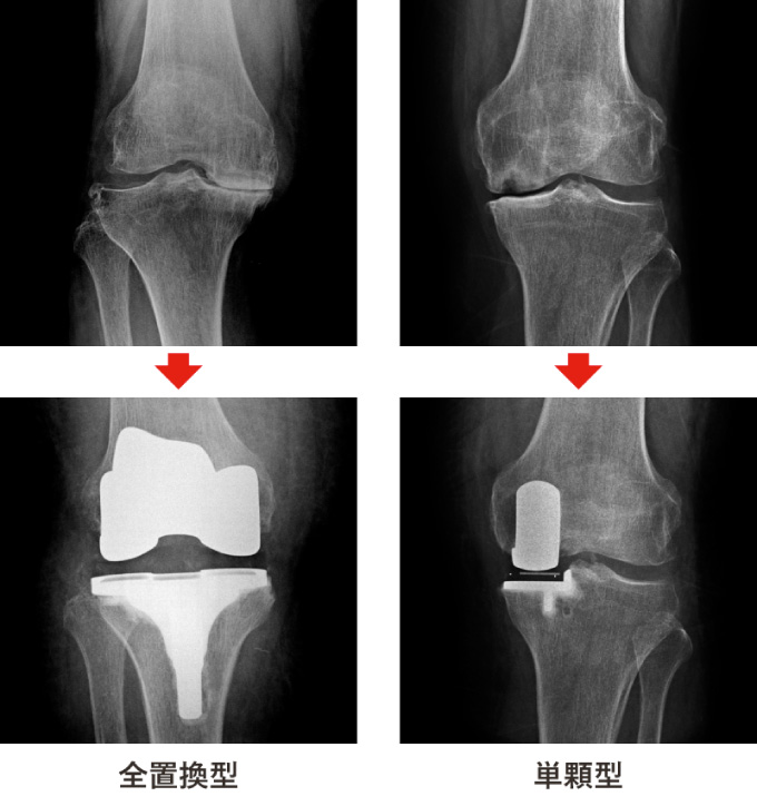 人工膝関節部分置換術(UKA)