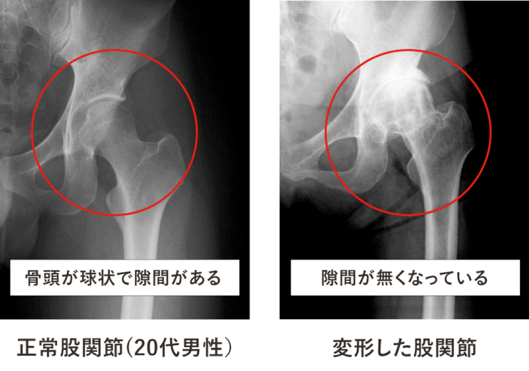 変形性股関節症のレントゲン画像