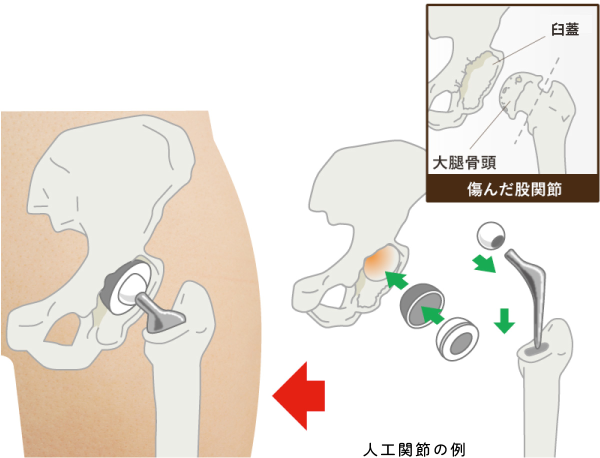 人工股関節置換術(THA)