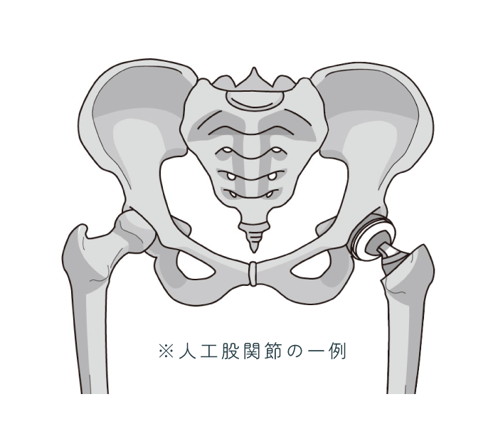 人工股関節の一例