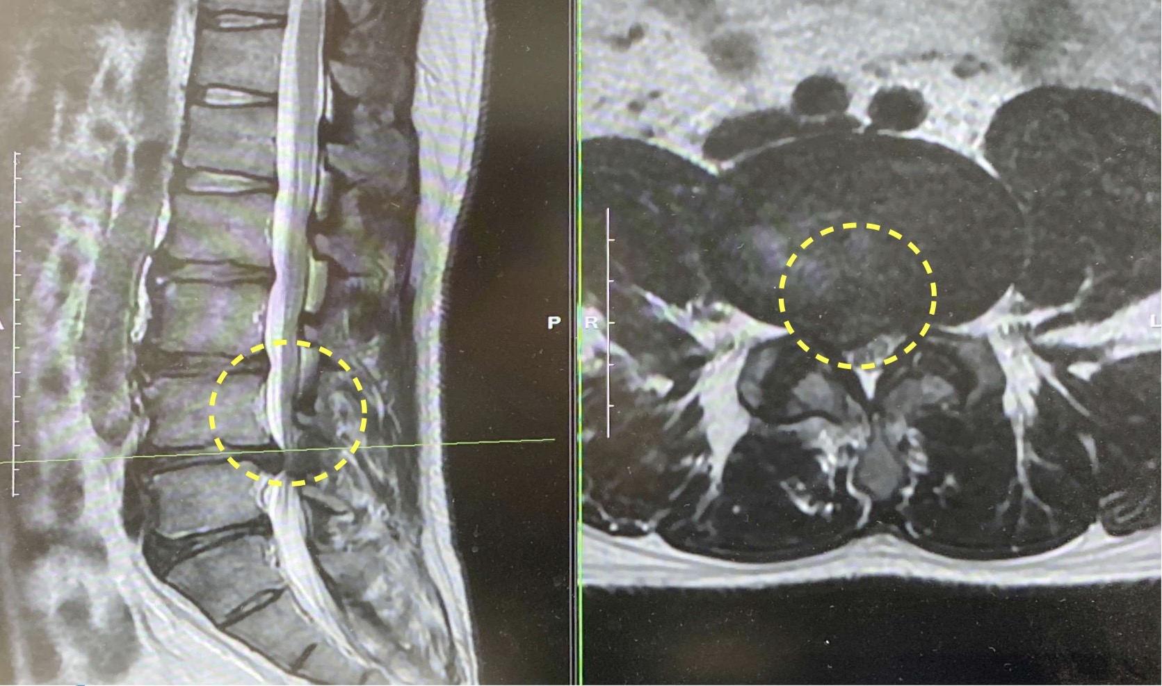腰椎椎間板ヘルニアの画像所見